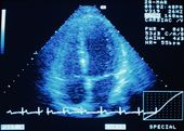Ultrasound Ultrasound